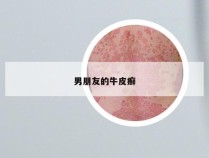男朋友的牛皮癣