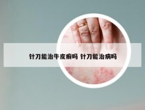 针刀能治牛皮癣吗 针刀能治病吗