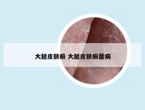 大腿皮肤癣 大腿皮肤癣菌病