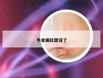 牛皮癣红斑没了