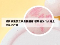 银屑病凌晨三四点特别痒 银屑病为什么晚上比早上严重