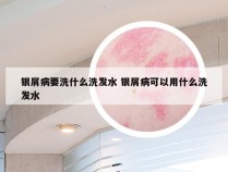 银屑病要洗什么洗发水 银屑病可以用什么洗发水
