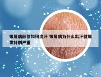 银屑病部位如何流汗 银屑病为什么出汗就爆发特别严重
