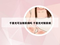 千里光可治银屑病吗 千里光对银屑病