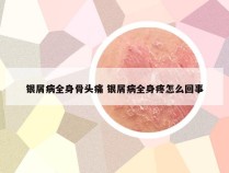银屑病全身骨头痛 银屑病全身疼怎么回事