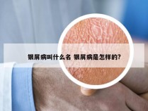 银屑病叫什么名 银屑病是怎样的?