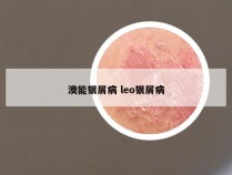 澳能银屑病 leo银屑病