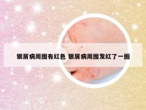 银屑病周围有红色 银屑病周围发红了一圈