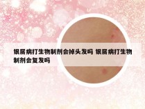 银屑病打生物制剂会掉头发吗 银屑病打生物制剂会复发吗