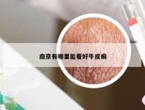 南京有哪里能看好牛皮癣