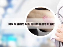 脚趾银屑病怎么治 脚趾银屑病怎么治疗