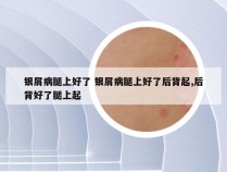 银屑病腿上好了 银屑病腿上好了后背起,后背好了腿上起