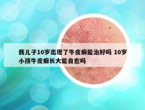 我儿子10岁出现了牛皮癣能治好吗 10岁小孩牛皮癣长大能自愈吗