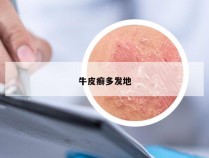 牛皮癣多发地