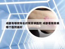 成都有哪些知名的银屑病医院 成都看银屑病哪个医院最好