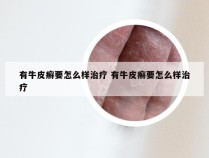 有牛皮癣要怎么样治疗 有牛皮癣要怎么样治疗
