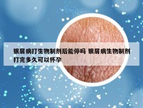 银屑病打生物制剂后能停吗 银屑病生物制剂打完多久可以怀孕