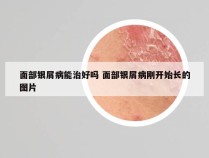 面部银屑病能治好吗 面部银屑病刚开始长的图片