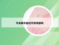 牛皮癣不能吃牛奶鸡蛋吗