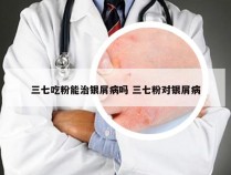 三七吃粉能治银屑病吗 三七粉对银屑病
