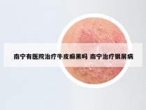 南宁有医院治疗牛皮癣黑吗 南宁治疗银屑病
