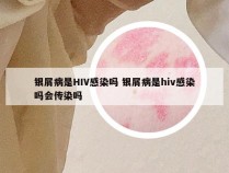 银屑病是HIV感染吗 银屑病是hiv感染吗会传染吗
