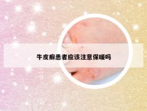 牛皮癣患者应该注意保暖吗