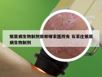 银屑病生物制剂邯郸哪家医院有 石家庄银屑病生物制剂