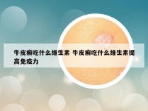 牛皮癣吃什么维生素 牛皮癣吃什么维生素提高免疫力