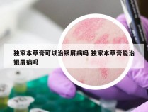 独家本草膏可以治银屑病吗 独家本草膏能治银屑病吗