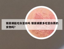 银屑病能吃白蛋白吗 银屑病要多吃蛋白质的食物吗?