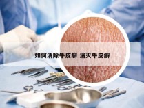 如何消除牛皮癣 消灭牛皮癣