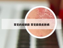 常见的皮肤藓 常见藓类皮肤病