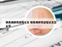 银屑病研究进程论文 银屑病研究进程论文怎么写