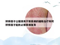 转移因子口服液用于银屑病的辅助治疗如何 转移因子能防止银屑病复发