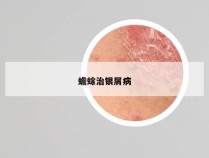 蟾蜍治银屑病
