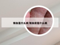 银血是什么病 银血症是什么病