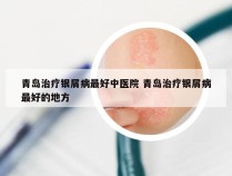 青岛治疗银屑病最好中医院 青岛治疗银屑病最好的地方