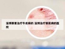 淄博那里治疗牛皮癣的 淄博治疗银屑病的医院
