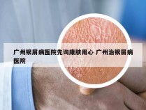 广州银屑病医院先询康肤用心 广州治银屑病医院