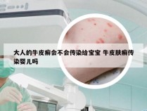 大人的牛皮癣会不会传染给宝宝 牛皮肤癣传染婴儿吗