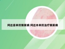 阿达目单抗银屑病 阿达木单抗治疗银屑病