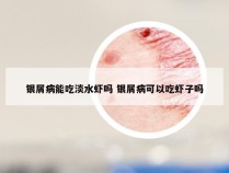 银屑病能吃淡水虾吗 银屑病可以吃虾子吗