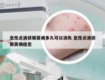 急性点滴状银屑病多久可以消失 急性点滴状银屑病痊愈
