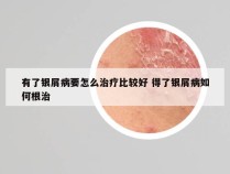 有了银屑病要怎么治疗比较好 得了银屑病如何根治