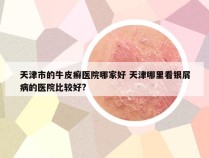 天津市的牛皮癣医院哪家好 天津哪里看银屑病的医院比较好?
