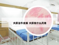 大蓟治牛皮癣 大蓟有什么药用