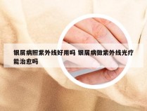 银屑病照紫外线好用吗 银屑病做紫外线光疗能治愈吗