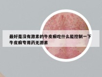 最好是没有激素的牛皮癣吃什么能控制一下 牛皮癣专用药无激素