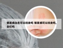 银屑病治愈可以纹身吗 银屑病可以纹身吗,会烂吗